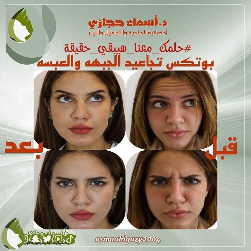 حقن البوتكس