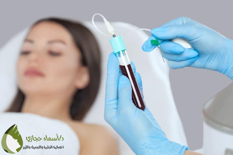 حقن بلازما الشعر