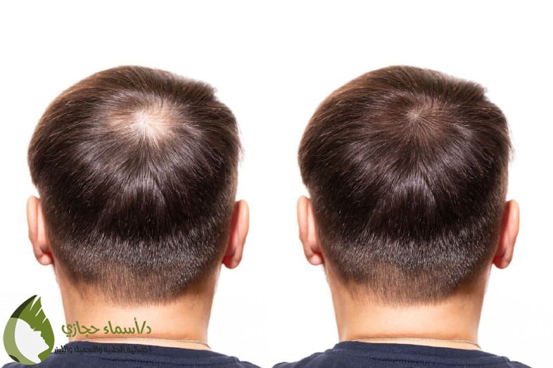 A00B7386 29Cd 4257 9F63 8A3C2974A919 | الموقع الالكتروني للدكتورة اسماء حجازي حقن بلازما الشعر