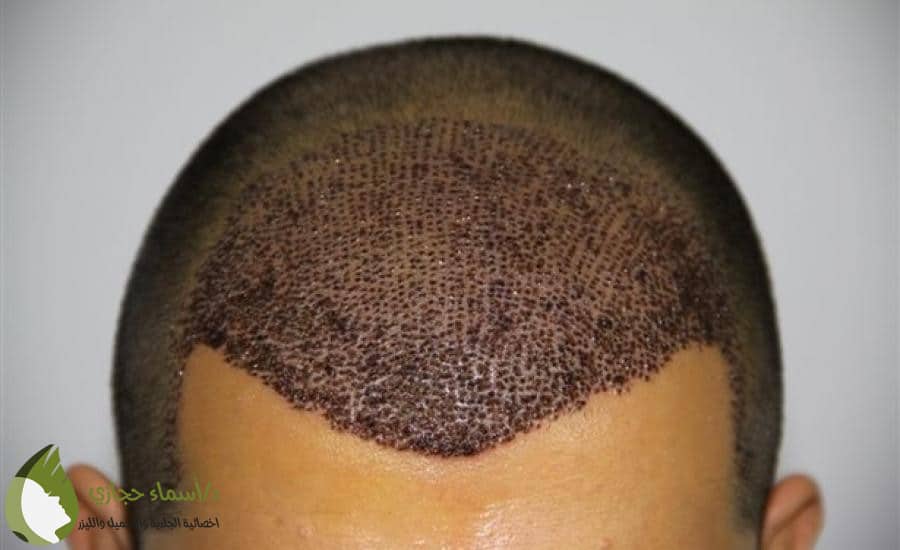 زراعة الشعر