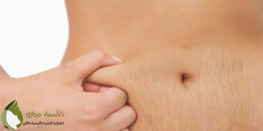 | الموقع الالكتروني للدكتورة اسماء حجازي علاج السترتش ماركس