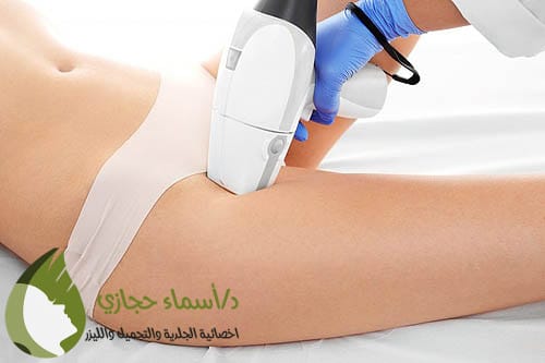 إزالة الشعر بالليزر