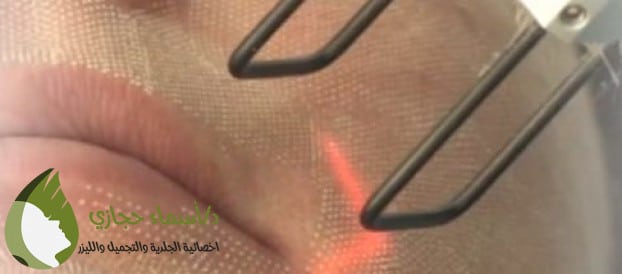 الليزر الكربوني و الفراكشنال ليزر