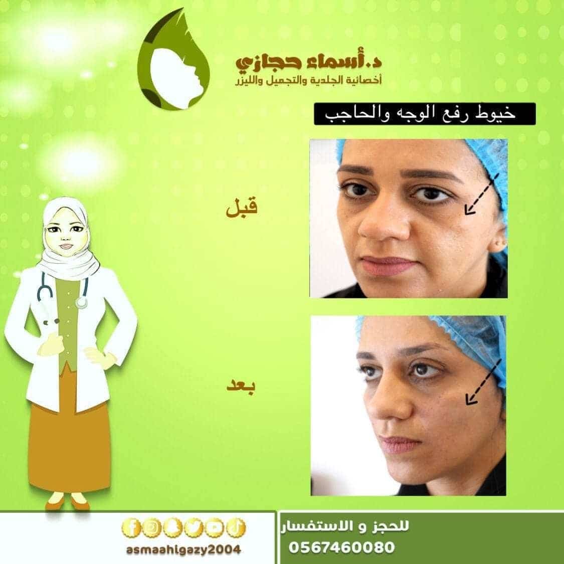 Photo 2021 03 01 23 43 22 2 | الموقع الالكتروني للدكتورة اسماء حجازي عملية شد الوجه بالخيوط قبل وبعد بالصور