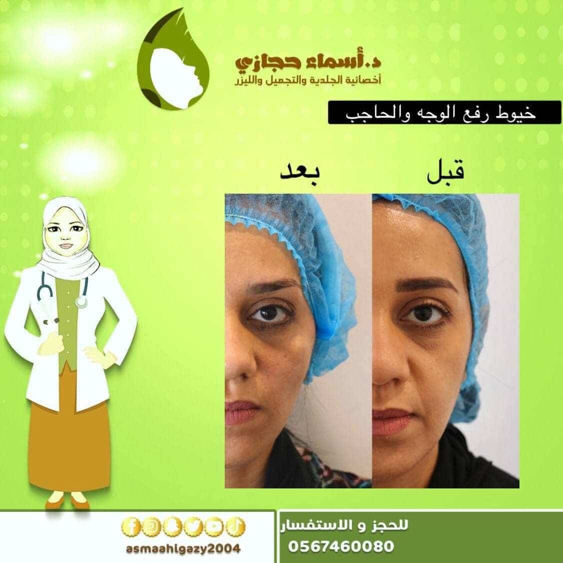 Photo 2021 03 01 23 43 24 2 | الموقع الالكتروني للدكتورة اسماء حجازي عملية شد الوجه بالخيوط قبل وبعد بالصور