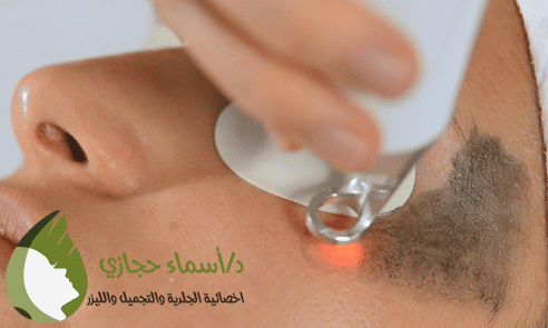 جلسات الليزر الكربوني للتصبغات