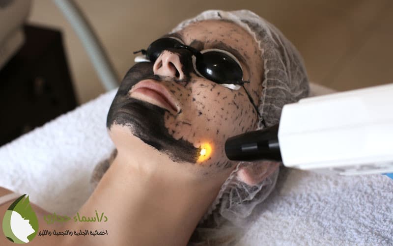 أضرار الليزر الكربوني