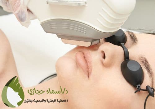 ازالة شعر الوجه بالليزر | الموقع الالكتروني للدكتورة اسماء حجازي إزالة شعر الوجه بالليزر