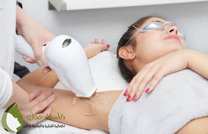 هل إزالة الشعر بالليزر دائمة؟