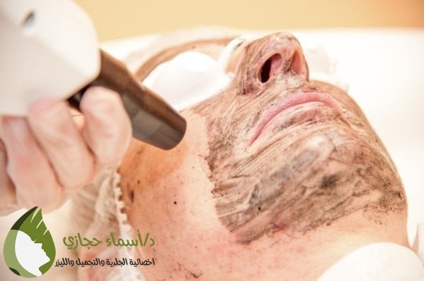 الليزر الكربوني للوجه | الموقع الالكتروني للدكتورة اسماء حجازي الليزر الكربوني للوجه قبل وبعد