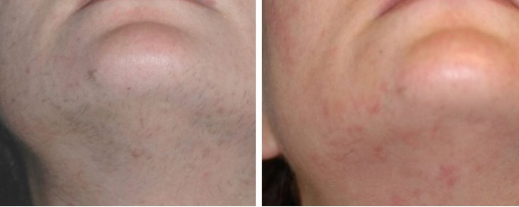 تجارب 3 | الموقع الالكتروني للدكتورة اسماء حجازي إزالة شعر الوجه بالليزر