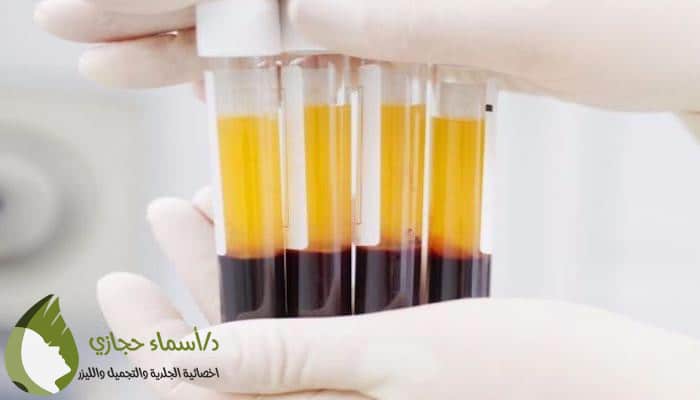 إبر بلازما للشعر