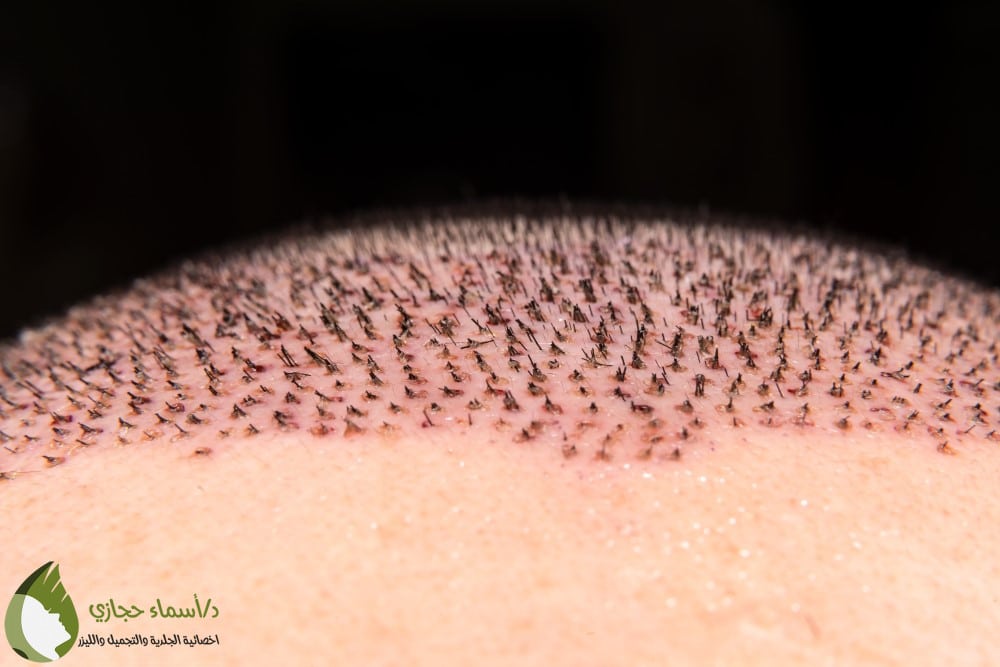 أضرار زراعة الشعر