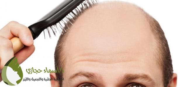 أضرار زراعة الشعر