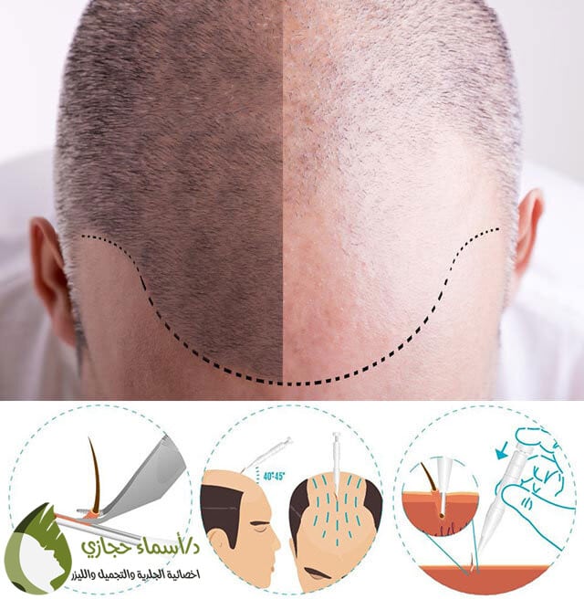 اضرار زراعة الشعر | الموقع الالكتروني للدكتورة اسماء حجازي أضرار زراعة الشعر