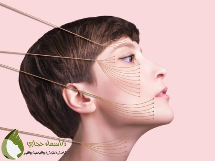 خيوط التجميل لشد الوجه