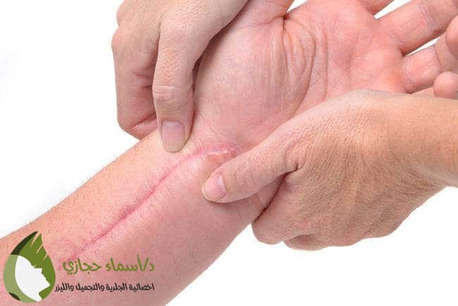 علاج ندبات الجروح