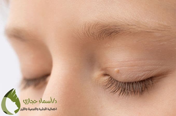 إزالة الزوائد الجلدية حول العين بالليزر