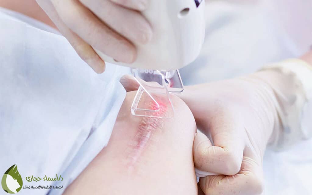 علاج ندبات الجروح