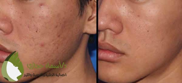 تجربتي مع الديرما بن