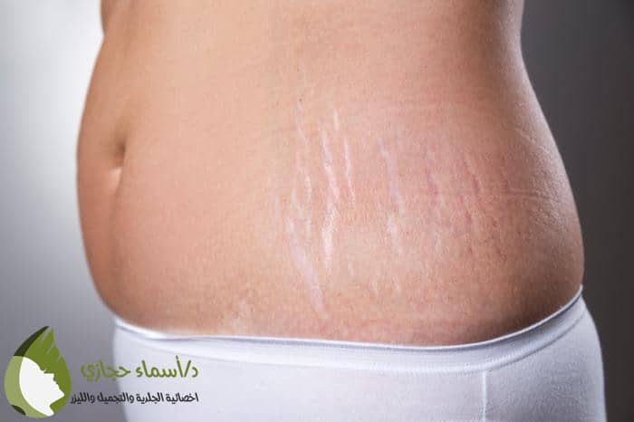 علاج علامات التمدد البيضاء بالليزر