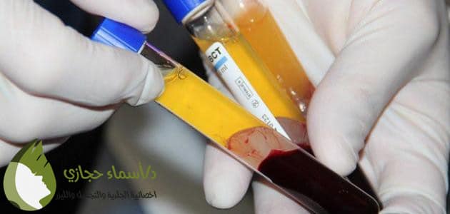 حقن بلازما الوجه
