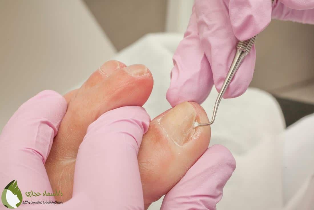 Ingrown Nails | الموقع الالكتروني للدكتورة اسماء حجازي علاج الظفر الغائر