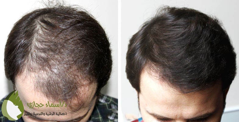 Xpecia 750Mg X 60 | الموقع الالكتروني للدكتورة اسماء حجازي زراعة الشعر بتقنية الاقتطاف