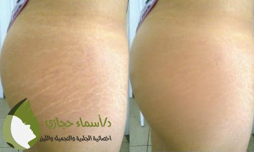علاج السترتش مارك الحمراء