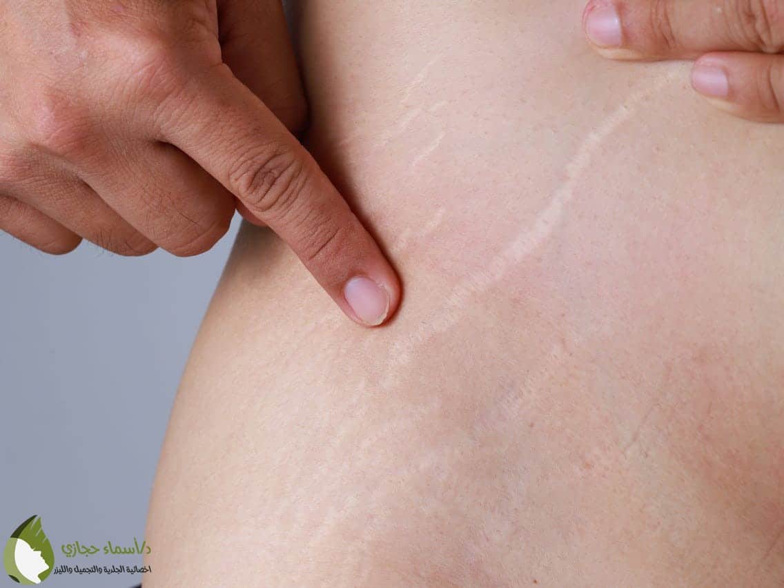 أسباب الاسترتش مارك