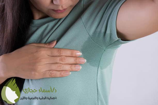 البوتكس لعلاج التعرق المفرط