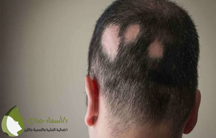 علاج الثعلبة