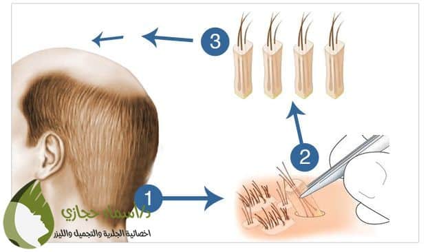 زراعة الشعر بتقنية الاقتطاف | الموقع الالكتروني للدكتورة اسماء حجازي زراعة الشعر بتقنية الاقتطاف