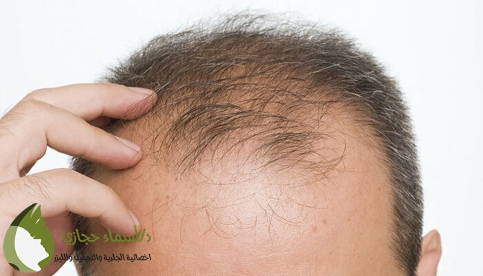 زراعة الشعر بتقنية الاقتطاف.Jpg 4 | الموقع الالكتروني للدكتورة اسماء حجازي زراعة الشعر بتقنية الاقتطاف
