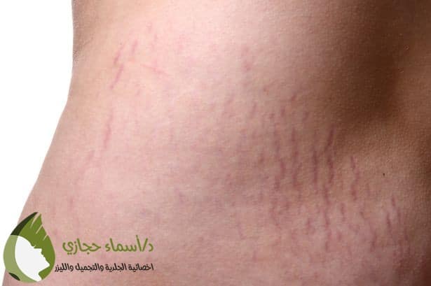 علاج السترتش مارك الحمراء