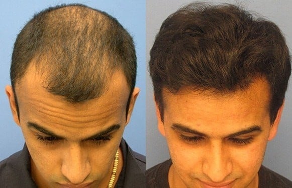 Biofibre Hair Implant 1 | الموقع الالكتروني للدكتورة اسماء حجازي عملية زراعة الشعر الصناعي Biofibre