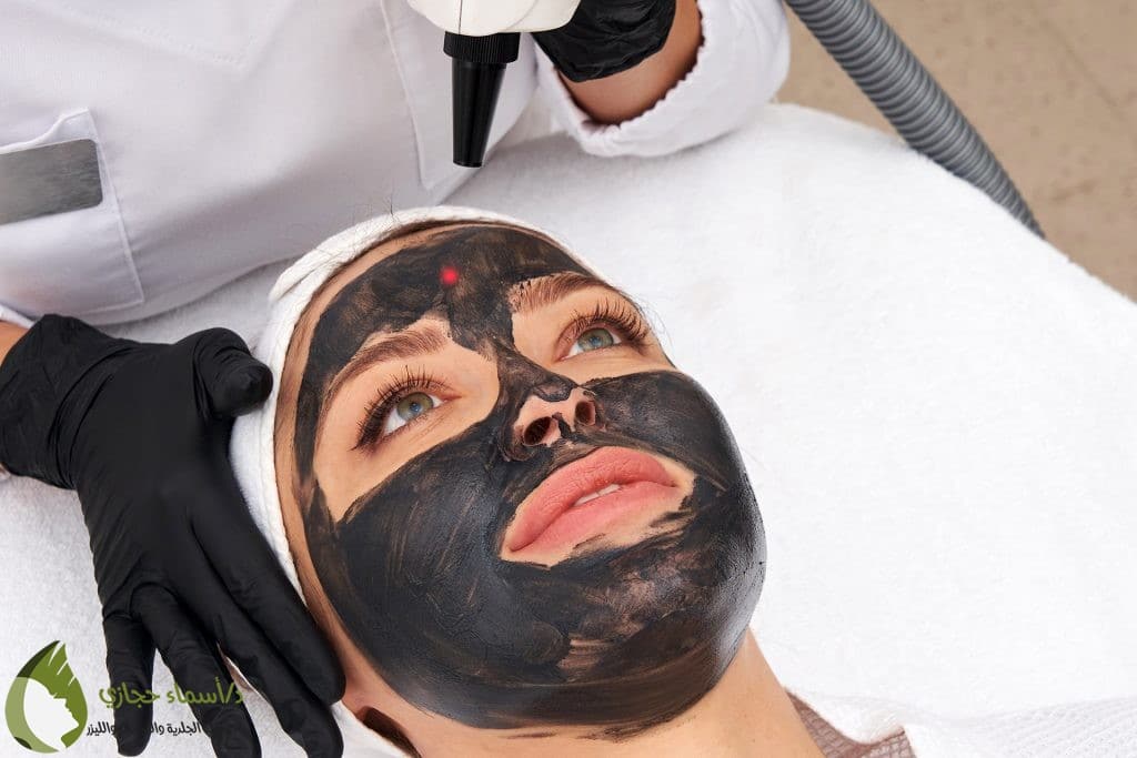 أسعار الليزر الكربوني