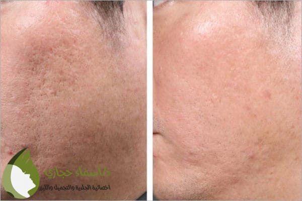 علاج الندبات والحفر