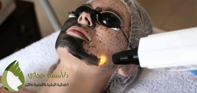 التقشير الكربوني | الموقع الالكتروني للدكتورة اسماء حجازي تقشير الوجه بالليزر الكربوني