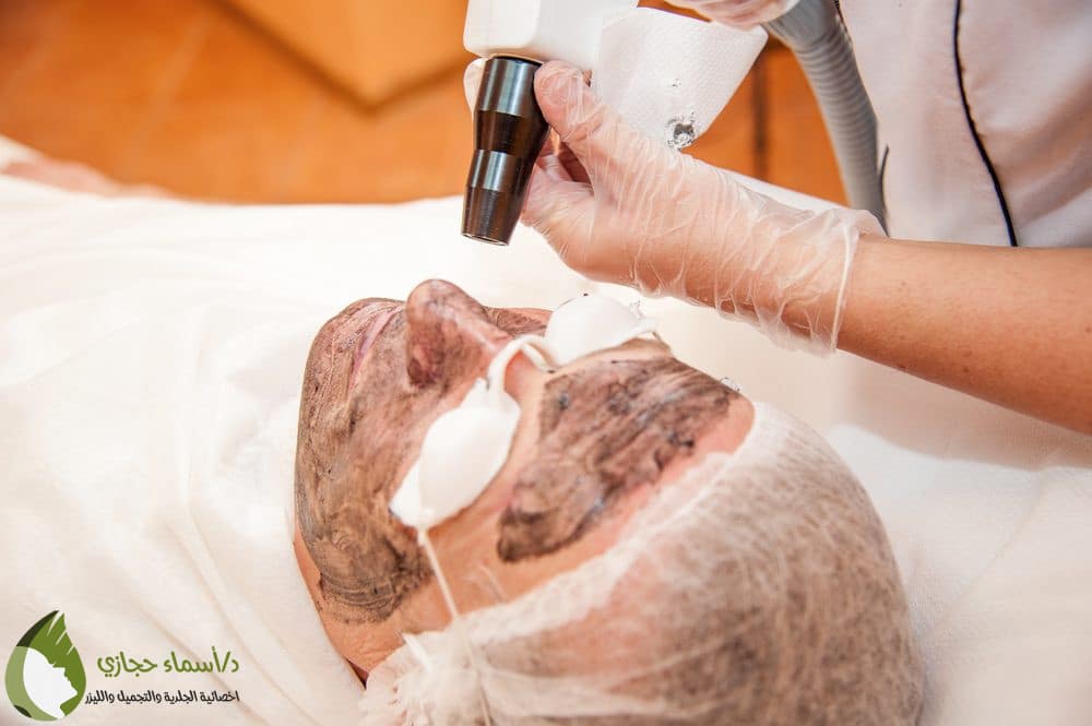 تقشير البشرة للحامل