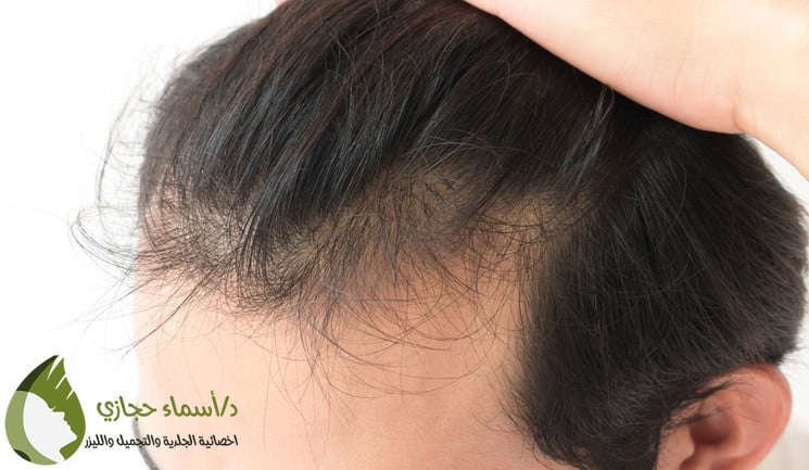 عملية زراعة الشعر الصناعي Biofibre