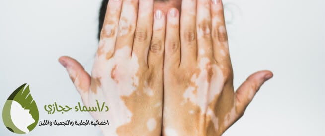 أسرع علاج للبهاق
