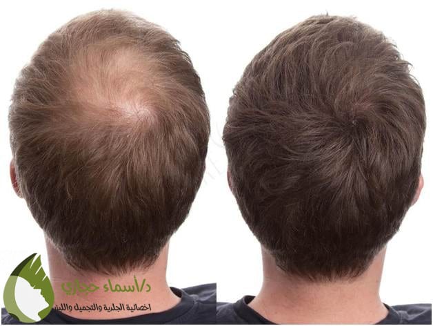متى تظهر نتائج الخلايا الجذعية للشعر