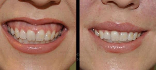 حقن Botox للشفايف 3 1 | الموقع الالكتروني للدكتورة اسماء حجازي حقن Botox للشفايف