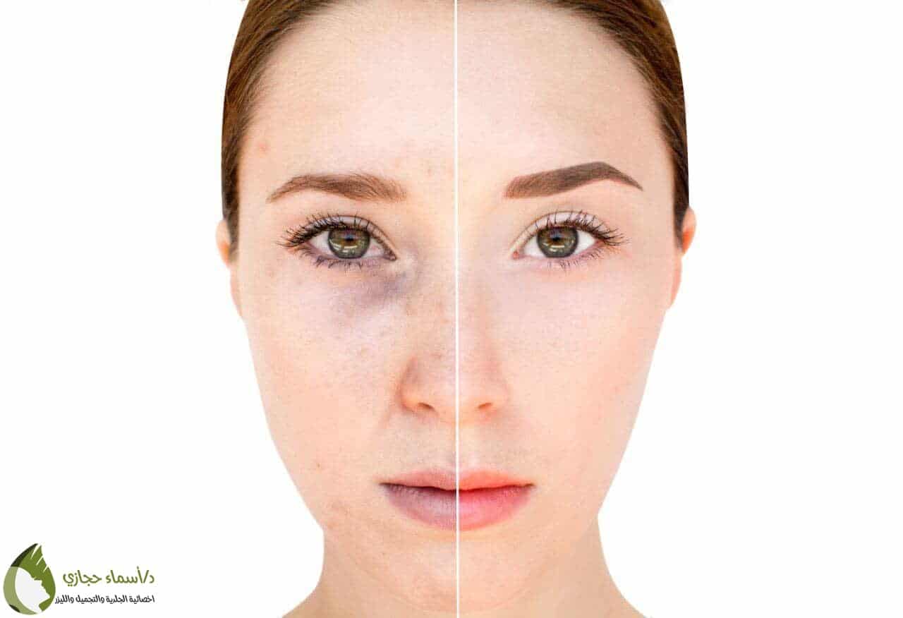 Dermapen | الموقع الالكتروني للدكتورة اسماء حجازي الديرمابن للوجه
