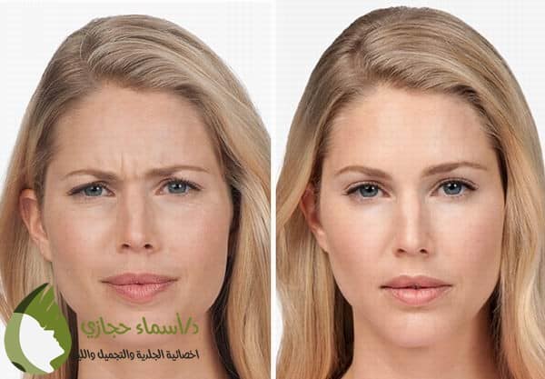 | الموقع الالكتروني للدكتورة اسماء حجازي تجاعيد بين الحاجبين