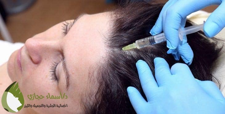 حقن الخلايا الجذعية للشعر