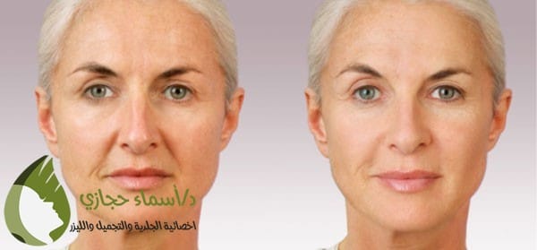 حقن الفيلر للوجه