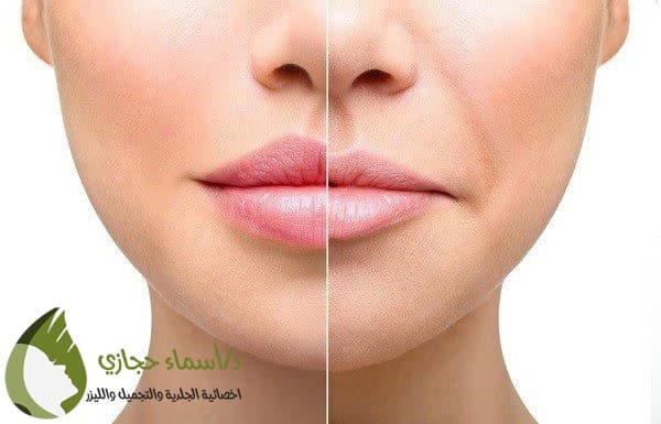 حقن الفيلر للوجه