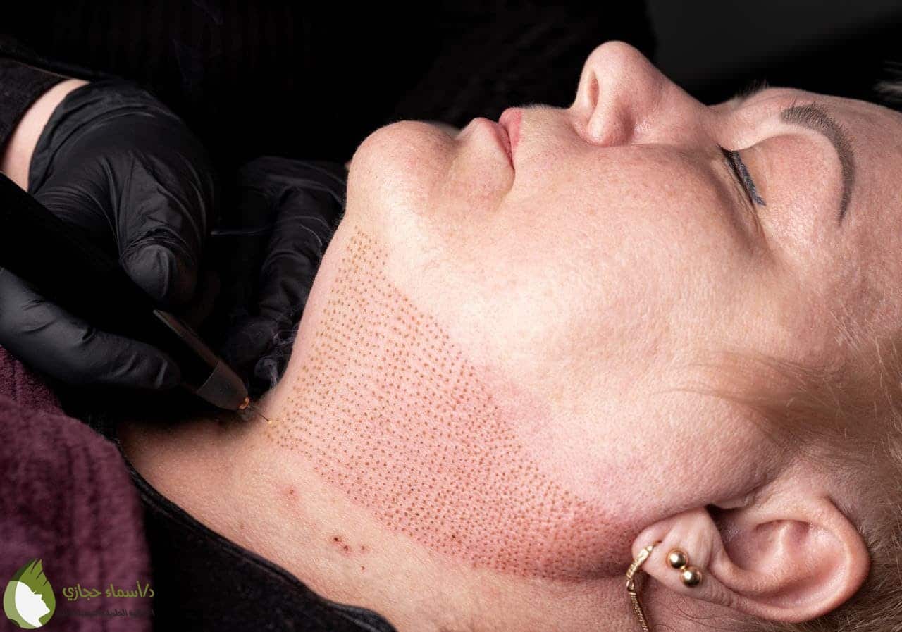 تقنية البلازماج